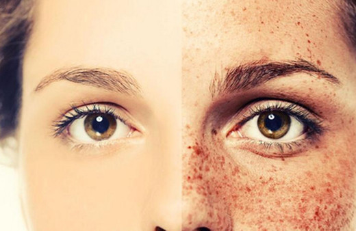 Çillere elveda.. Çilleri yok eden 8 doğal yöntem