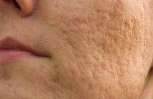 Sivilce lekeleri nasıl geçer sivilce lekelerinden kurtulmak için altın değerinde tüyolar!