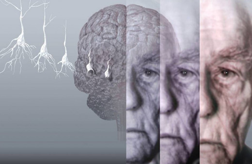 Alzheimer'ın farkında olun ve önleyin! Erken teşhis etmeyi sağlayan o davranışlar...