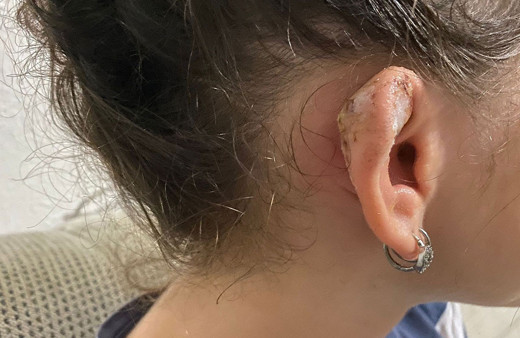 Küpe takmak için takıcıda deldirdiği kulağı hayatını kabusa çevirdi!