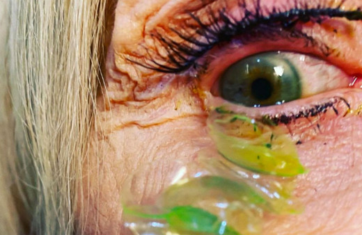 Gözündeki lensi unuttu her sabah yenisini taktı! Unutulan 23 lens gözü bakın ne hale getirdi