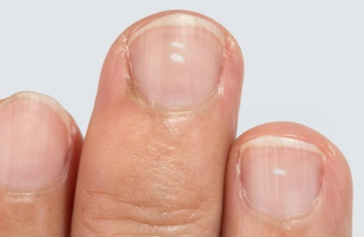 Tırnaklarda beyaz lekeler neden olur nasıl geçer? Bu besinleri tüketin etkiyi görün!