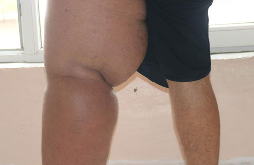 5 yıldır gitmediği hastane kalmadı: Kaza sonrası ayağı şişen gencin hayatı kabusa döndü!