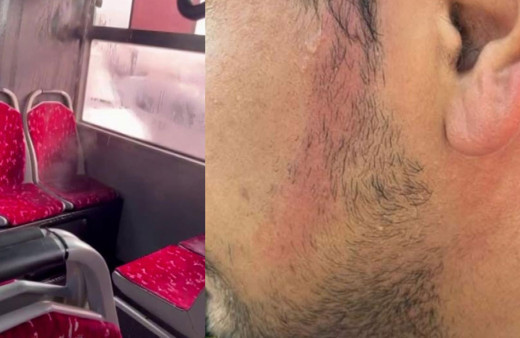 İETT otobüsünde klima borusu vatandaşın yüzüne patladı