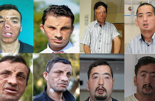 Türkiye'de ilk yüz nakli yapılan isimlerdi! Uğur Acar ve Turan Çolak'ın 10 yıl sonraki haline bakın