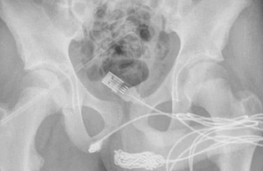 Tıp literatürüne girdi! Merakı başına bela oldu: Doktorlar cinsel organından ameliyatla bakın ne çıkardılar!