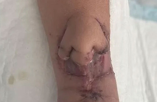 Burnu kolunda yeniden çıktı! Tıp dünyasında çığır açan buluş