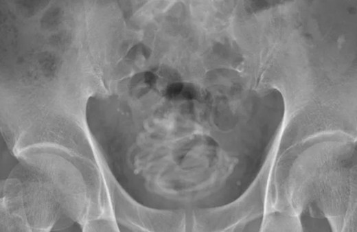 Tam tamına 2 metre! 79 yaşındaki adamın cinsel organından çıkardılar!