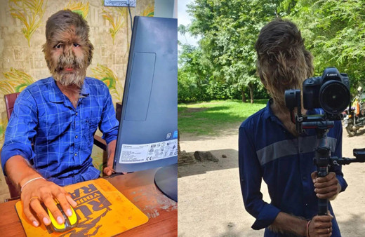 Sadece 50 kişide görülen hastalık! Kurt Adam hayat hikayesini anlattı: "İnsanlar üzerime taş atardı, hayalim Youtuber olmak"