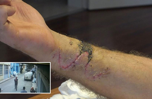 Bursa'da anlaşmazlık yaşadığı arkadaşına pusu kurup Pitbulla saldırdı 3 gün yoğun bakımda kaldı