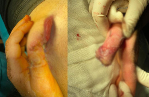 Kazada yarısını kaybetmişti: Kopan parmağını göbeğine dikerek kurtardılar!