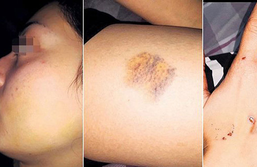 Yeni evli kadına kocası kabusu yaşattı! Dövüp vücudunda sigara söndürdü