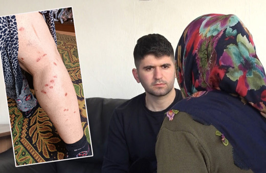 Zeliha'yı lazer epilasyonda yaktılar! Peşin parayla tüylerinden kurtulmak isterken....