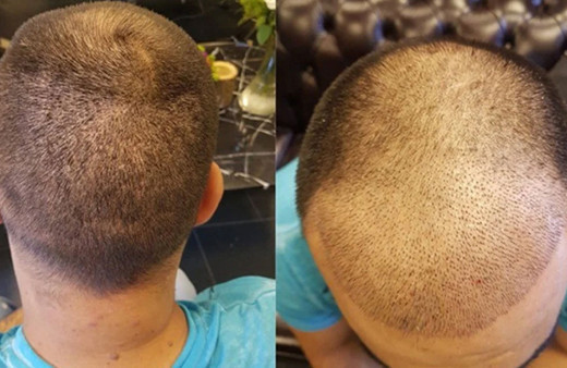 Geçtiğimiz yıl 1 milyon kişi Türkiye'ye saç ektirmeye geldi