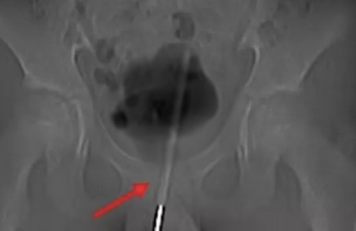 12 yaşındaki çocuğun cinsel organından çıktı! Annesi gerçeği itiraf etti