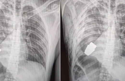 Böylesi ilk kez duyuldu! Vücudundan patlamamış el bombası çıktı