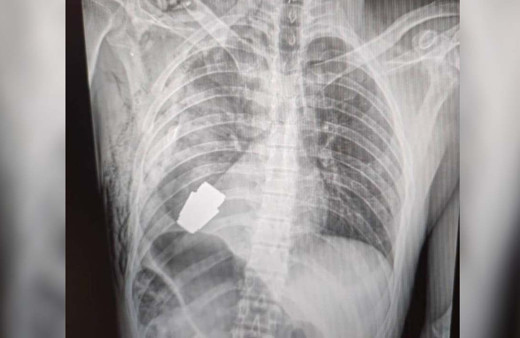 Dünyanın en tehlikeli ameliyatı... Doktor havaya uçmadan işini tamamladı