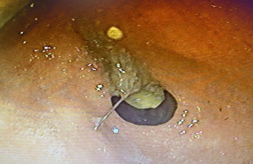 İki çocuk annesi hapşırınca yuttu! Yaklaşık 3,5 santim midesinden çıkarıldı