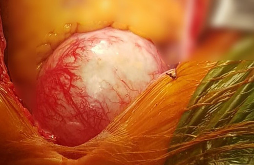 Gelmiş geçmiş en nadir olay! Aort damarı normalden 3 kat fazla büyüdü: Hasta ölümden döndü