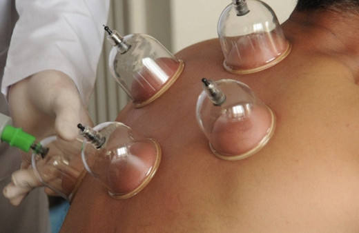 Diyanet'ten hacamat yaptırmak Ramazan'da orucu bozar mı sorusuna yanıt