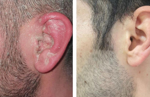 Sedef hastalarına, ev yoğurdu ve Akdeniz tipi beslenme tavsiyesi