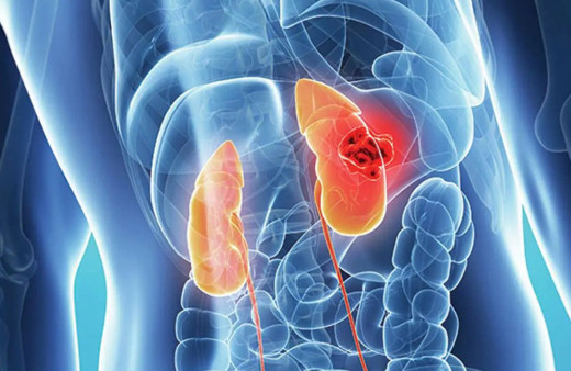 Böbrek kanseri nedir? Böbrek kanseri belirtileri neler, tedavisi nasıl yapılır?