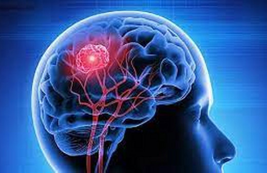 Invamed'den beyin anevrizmasına ameliyatsız çözüm