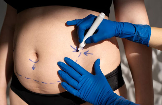 Aman dikkat! Liposuction kilo verdirme ameliyatı değildir!