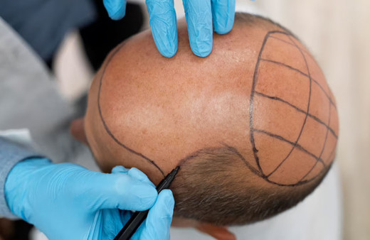 İğne fobisi olanlar da bu yöntemle saç ektirebilir