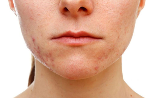 Makyaj yapmadan iyi düşünün! Cildiniz sizi üzebilir