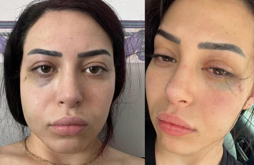 GKRY’de 25 yaşındaki Türk kızına saldıran 2 Rum tutuklandı