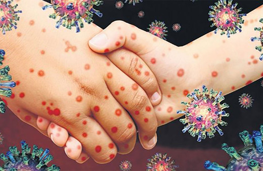 İstanbul'da yeni salgın patladı! Kızamık nedeniyle çocuklar ölmeye başladı! 'Aşı yaptırın' uyarısı geldi