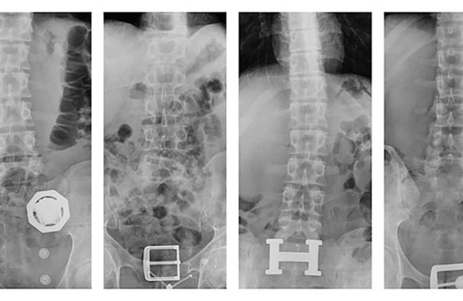 Diyarbakır'da tedirgin haller sergileyen 4 kişi yakayı ele verdi! Midelerinden çıktı: 121 parça halinde...