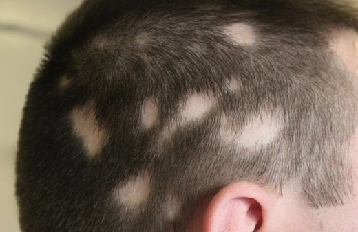 Saç kıran hastalığı nedir? Nasıl bulaşır, tedavi edilmezse ne olur? Kalıcı mı, nasıl geçer?