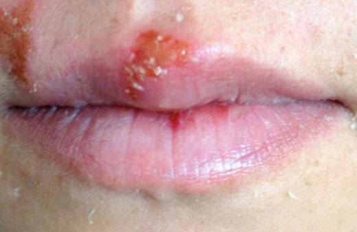 Uçuk deyip geçmeyin! Pek çok soruna neden oluyor!