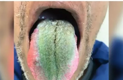 Dili bir anda tüylenmeye başladı ve yeşile döndü! Sebebi sigara mı yoksa...