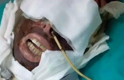 Saplantılı aşığın kimyasal maddeyle yaktığı kadın hakkında rapor: Engel oranı yüzde 95