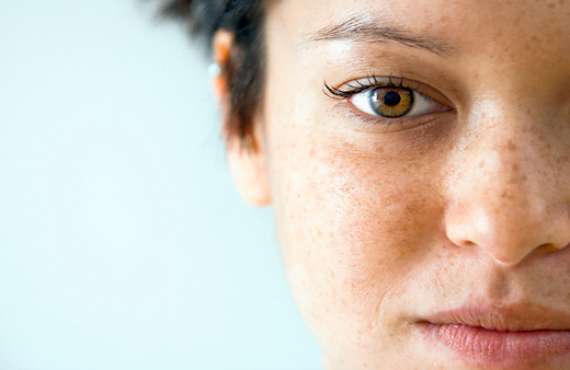 Ciltteki koyu lekelere ve benlere dikkat! Uzmanlar uyardı "Ölümcüllük oranı yüksek"