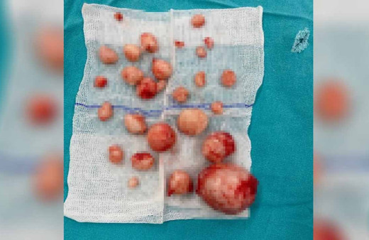 Tam 26 adet! Hepsi 40 yaşındaki kadının rahminden çıktı