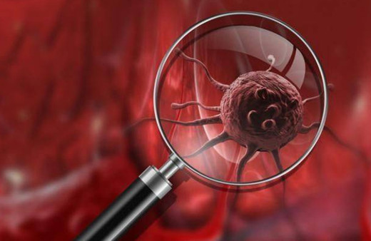 Depresyon ve kaygı kansere yol açar mı? Araştırmada ilginç sonuçlar