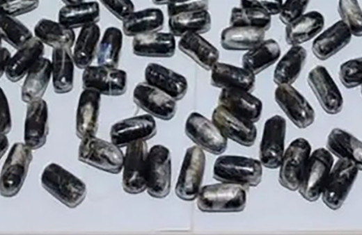 Hepsi bir kişinin midesinden çıktı! Erzincan'da akıllara durgunluk veren olay