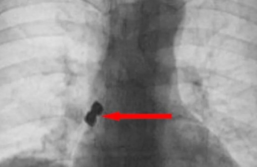 Diş tedavisinde hastanın başına geleni duyanlar şaştı kaldı ölümden döndü