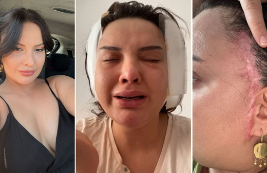 'Badem Göz' olmak için estetik masasına yattı sona faciayla bitti! Eski halinden eser yok şimdi