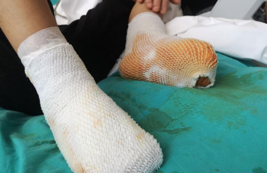 Erzurum'da çayırda elektrik akımına kapılan çocuk ölümden döndü!