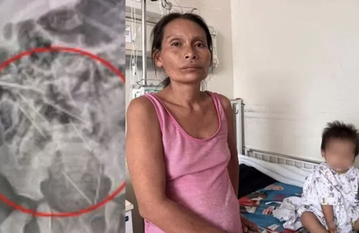 İki yaşındaki çocuğun midesinden çıkanlar dehşete düşürdü!