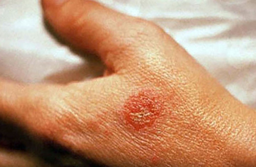 Mevsimi geldi, uzmanlar uyardı! Alerjik egzama için alınacak önlemler...