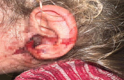 3 yaşındaki kızın kulağından çıkanlar doktorları şok etti! Canlı canlı 23 tane çıkarttılar