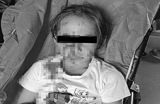 Esenyurt'ta başıboş köpek 6 yaşındaki kızın yüzünü parçaladı!