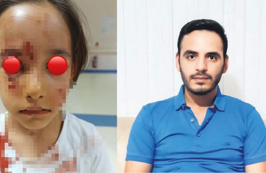 İstanbul'da başıboş köpek dehşeti! 6 yaşındaki kızın yüzünü parçaladı! Küçük kız kuduz mu oldu?