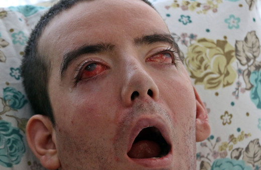 Görme bozukluğuyla başladı! 10 yıldır gözlerini kapatamıyor